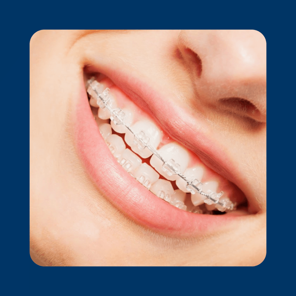 Achieve a Confident Smile with Our Expert Braces Dentist Dental Home