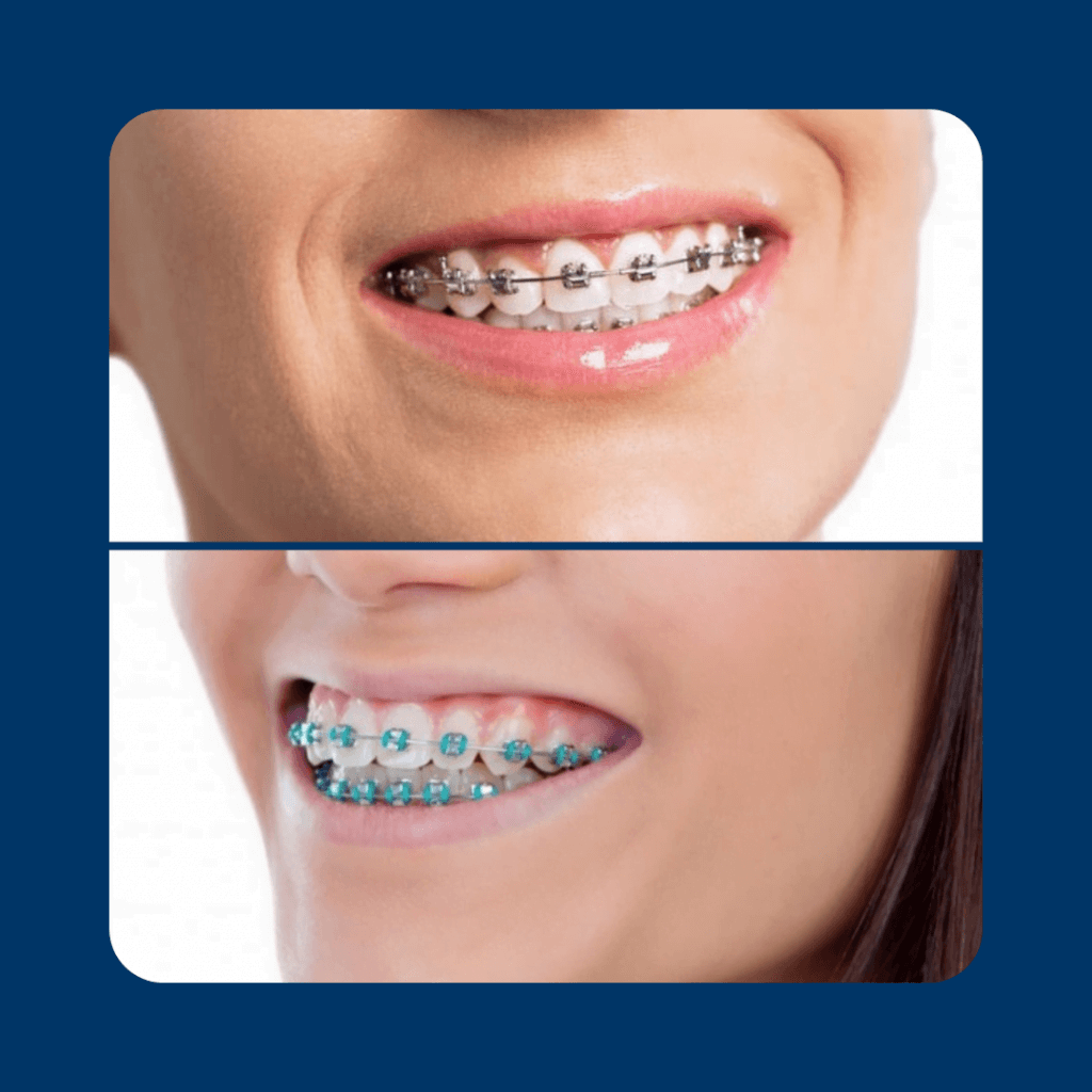 Achieve a Confident Smile with Our Expert Braces Dentist Dental Home