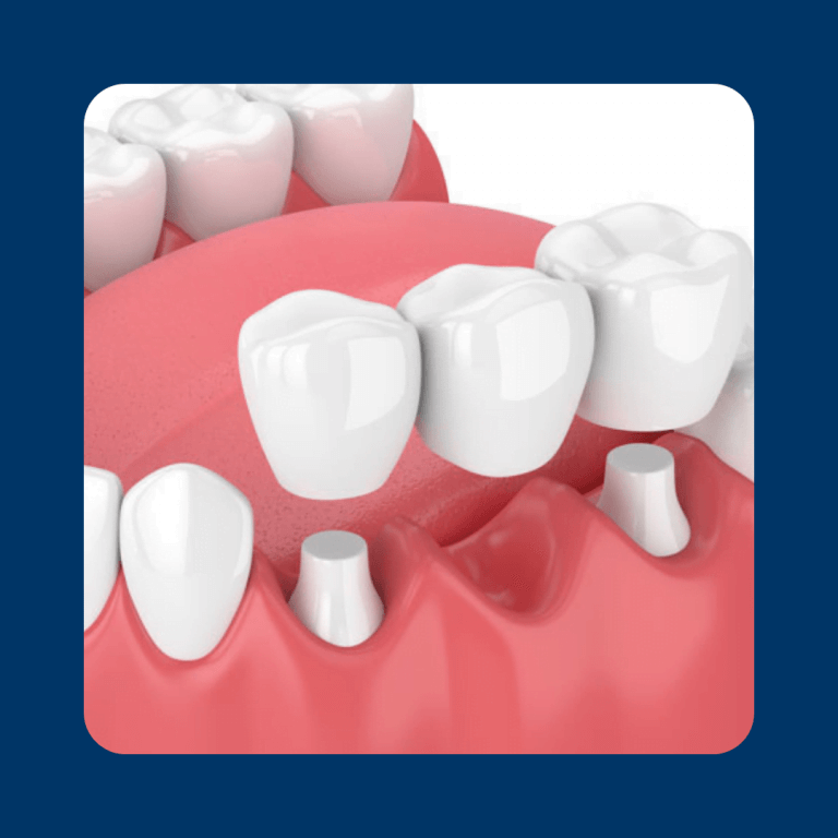 When do I need a tooth bridge treatment?