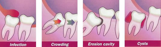 When Do I Need To Have My Wisdom Teeth Extracted?